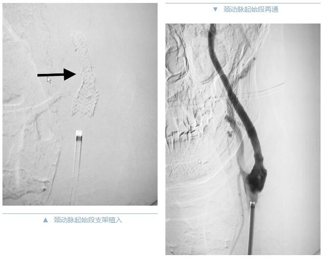 拼3-颈动脉支架植入、再通.jpg