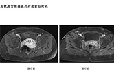 局晚期宫颈癌放疗疗效前后对比1