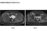 局晚期宫颈癌放疗疗效前后对比2