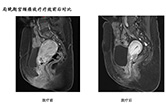 局晚期宫颈癌放疗疗效前后对比3