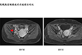 局晚期宫颈癌放疗疗效前后对比5